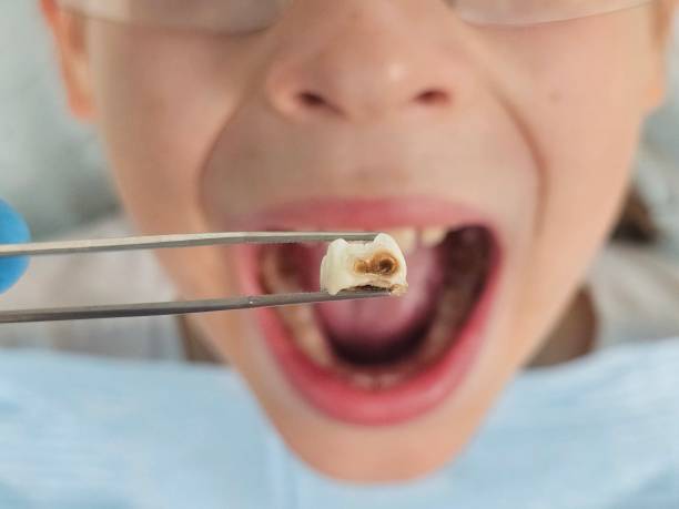 Best Dentist for Tooth Abscess  in Walnut Hill, TN